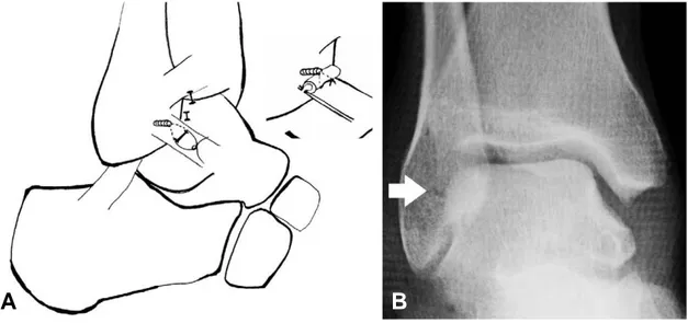 Fig. 6. (A) two strands were passed to distal accessory portal. (B) the gap between anterior talfibular ligament complex and the fibu- fibu-lar side was tightened.