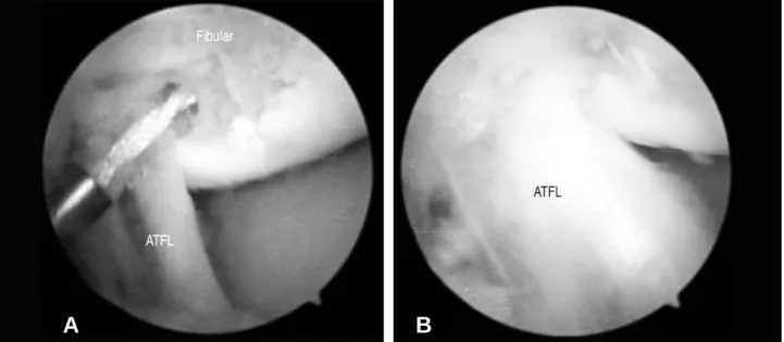Fig. 7. Case 2 (A) We made the drill hole at the fibular ATFL proximal attachment site