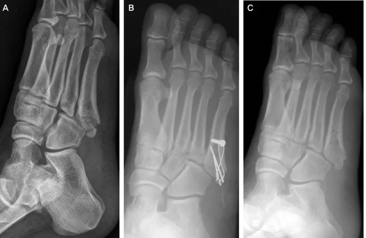 Figure 1. 36-year-old man with Jones fracture. (A) Initial foot oblique view with Lawrence zone II area, communited fracture