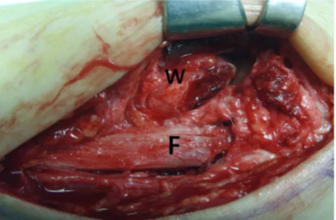 Figure 4. Operative finding of the type III anterior inferior tibiofibular  ligament avulsion fracture (F: fibula, W: Wagstaffe fragment).