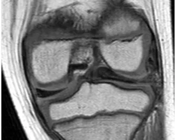 Fig. 2. Coronal magnetic resonance imaging of lateral discoid meniscus with tear in the left Knee