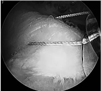 Fig. 1. Arthroscopic subacromial view shows the prepara- prepara-tion of the suture material
