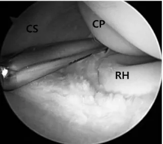 Fig. 2. The ECRB tendon was separated from the proximal origin at the lateral epicondyle by using a radiofrequency device (CP capitellum).