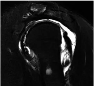 Fig. 1. After examining a series of consecutive oblique sagittal T2-weighted MRI , the maximum AP diameter of a tear was measured.