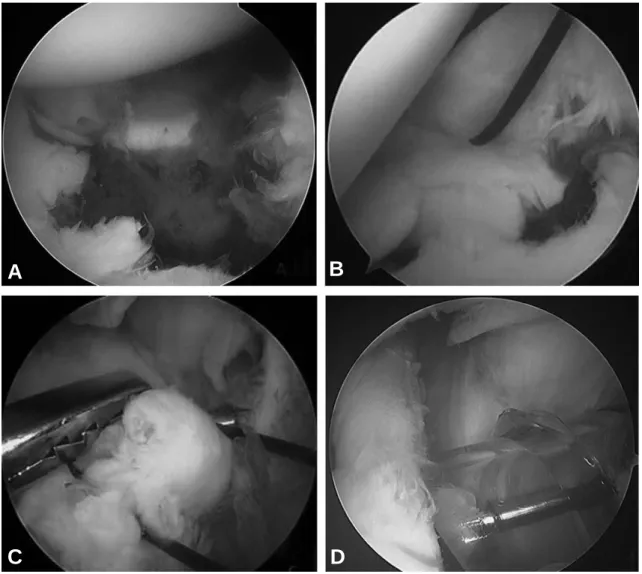 Fig. 3. The arthroscopic views of operative procedure: (A) Arthroscopic views demonstrating comminuted and rotat- rotat-ed glenoid fracture fragments