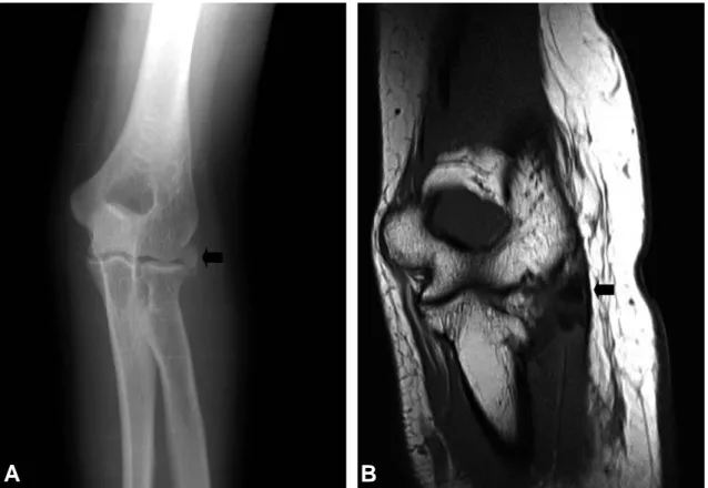 Fig. 1. Preoperative imagings of left elbow. (A)  Radiograph (anteroposterior view) shows calcific deposits (black arrow) at the origin of common extensor tendons