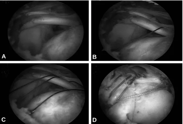 Fig. 1. Procedures of margin convergence technique for massive rotator cuff tear. (A) We used margin convergence technique for a U-shape tear