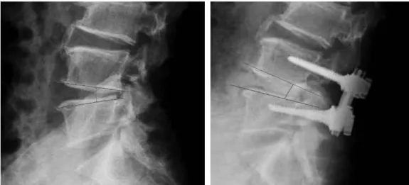 Fig. 2. The disc height was measured on the preoperative and postoperative lateral plain radiographs.