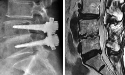 Table 2. The Changes of Disc Height on Lateral Radiograph