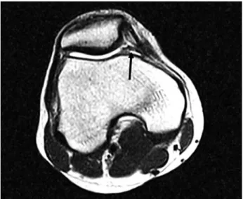 Fig. 2. The bucket handle portion is engaged in the patellofemoral joint during the knee flexion.