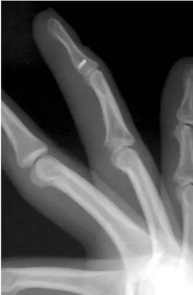 Fig. 6. 10 weeks after the operation, the range of motion of the DIP joint was 5 degrees to 40 degrees.