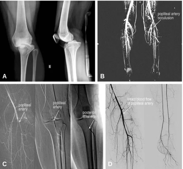 Fig. 1. (A) The simple x-rays showed dislocated knee joint and reduced state after manual method