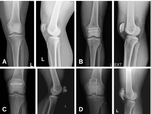 Fig. 1. (A) Initial radiograph shows displaced vertical fracture of patella. (B) Immediate postoperative radiograph shows transverse screw fixation with cannulated screws