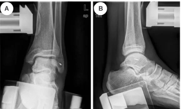 Fig. 3. (A-B) Postoperative stress radiographs show proper placement of single suture anchor in fibula.
