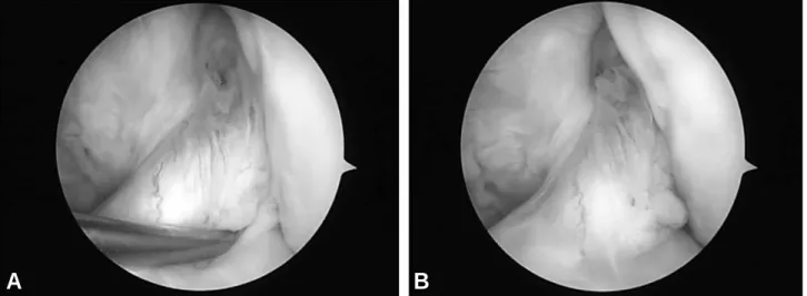 Fig. 1. Second look arthroscopic finding shows normal tension and good synovial coverage with hamstring tendon autograft.