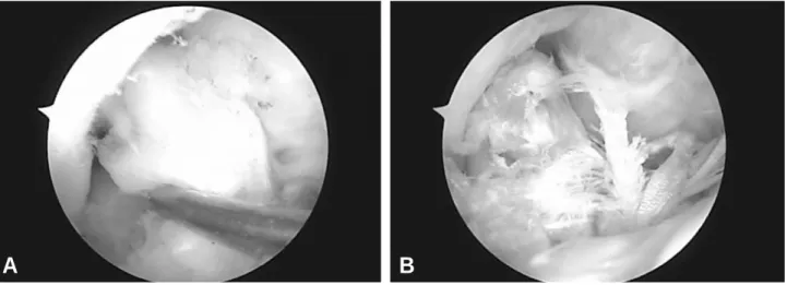 Table 4. Comparison of Graft Tension and Synovial Coverage at Second Look Arthroscopy
