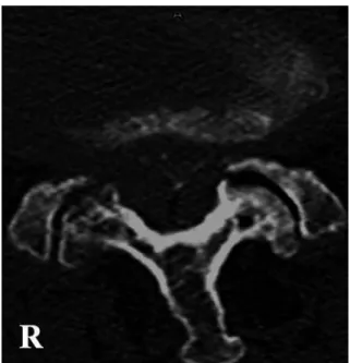 Fig. 1. Plain radiographs showing sacralization of the fifth lumbar (L5) vertebra and spondylotic changes.
