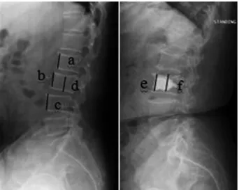 Fig. 1. The method used for determining vertebral body height restoration rate. Vertebral body height before compression fracture (Y): Y = (a + c)/2