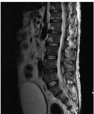 Fig. 3. After partial laminectomy at L5/S1, the massive hematoma (with a fluid-feature) was drained.