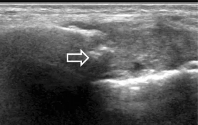 Fig. 1. Ultrasonographic finding of hyperechoic ossi- ossi-fied callus formation (arrow).