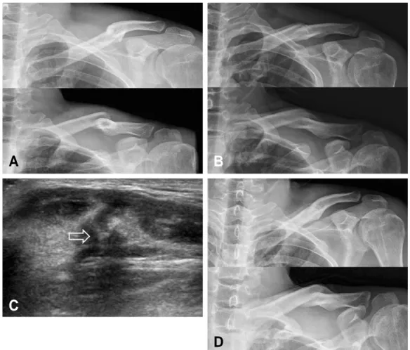 Fig. 2. A 37-year-old male patient confessed feeling pain in the left shoulder. (A) Initial X-ray showed Robinson classification type 2B1 midshaft fracture in the left clavicle