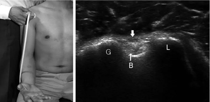 Fig. 1. Short axis scanning of long head of biceps tendon. Scan shows hyperechoic biceps tendon within the bicip- bicip-ital groove (B)