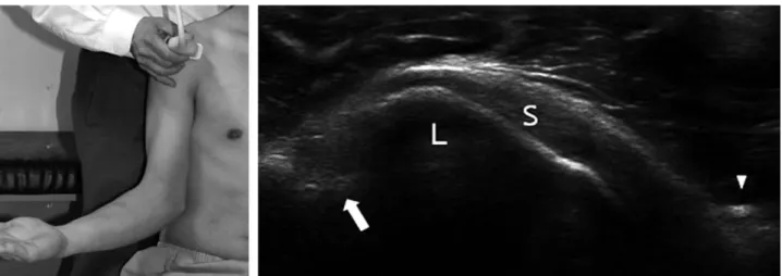 Fig. 3. Long axis scanning of subscapularis tendon. Scan shows subscapularis tendon (S), lesser tuberosity (L) and coracoid process (arrow head)