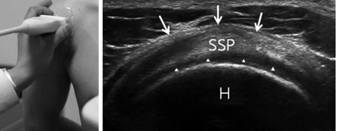 Fig. 6. Short axis scanning of supraspinatus tendon. Scan shows supraspinatus tendon is located between articu- articu-lar cartilage (arrow head) and subdeltoid bulsa (arrow) (SSP: supraspinatus tendon, H: humeral head).