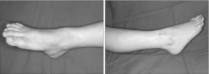 Figure 10. Note the good range of motion of the ankle joint.