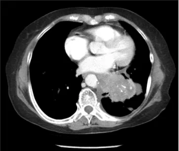 Figure 1. CT scan of the chest showed huge mass on the left lower lung  field, corresponding with small cell lung cancer (SCLC).
