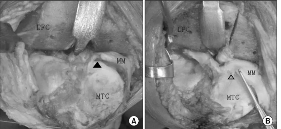Fig. 1.  We  checked  the  existence of the root tear of  medial meniscus grossly in the  operative field