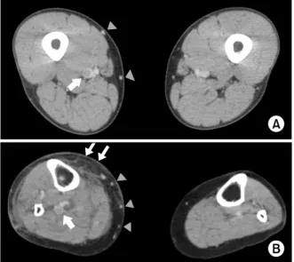 Fig. 2. This 78-year-old woman who underwent total knee  arthroplasty  on  her  left  knee,  was  diagnosed  deep  vein  thrombosis at the popliteal area by computed tomographic  venography