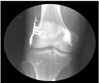 Fig. 1.  The  evaluation  of  graft-bone  interface  using  the  arthrography.학적 연구가 이루어져 있으나1,4,7-11,17,22) 사람의 전방 십자 인대 재건술 후 이식건과 골간 접촉면에 대한 연구는 많지 않다12,13,15,16,21)