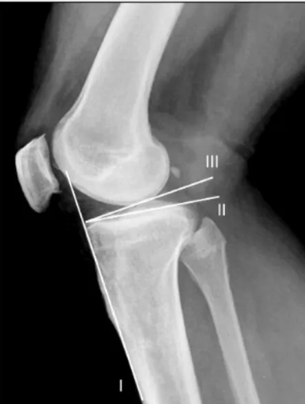 Fig. 2.  Radiograph  showing  determination  of  the  patellar  height according to the Blackburne-Peel index