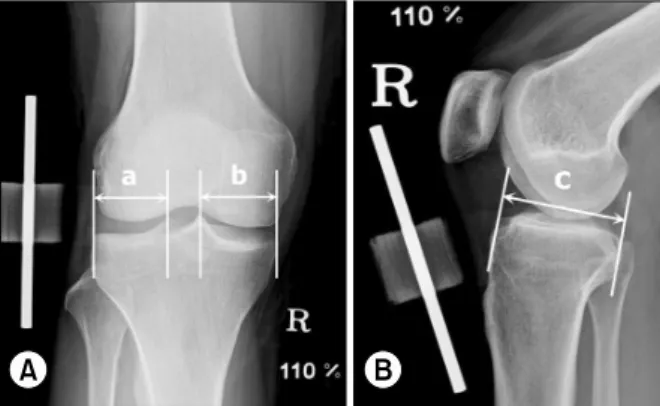 Fig. 1. The size of allograft is measured using the magnifi- magnifi-cation controlled plain radiographs