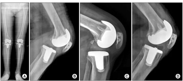 Fig. 1. (A) Standing-extrimity radiograph of the first case. (B) Radiography showing the posterior dislocation of total knee  replacement