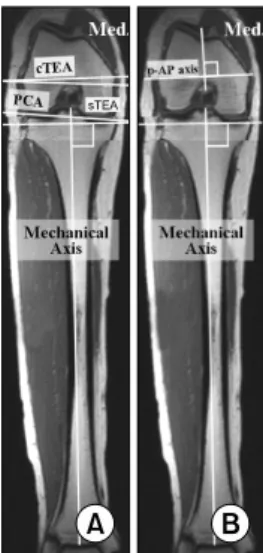 Fig. 1.  MRI  scans  show  the  coronal  views  of  the  distal  femur and entire tibia at 90 o  of knee flexion (the images  were reconstructed using suitable images that contained the  reference points)