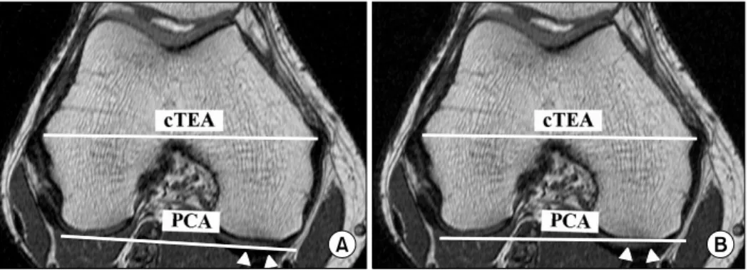 Fig. 3. The MR images to assess the changes in the rotational alignment, as determined by PCA, due to the asymmetric  cartilage erosion that’s expected in varus osteoarthritis patients