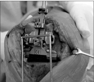 Fig. 1. Modified gap technique using ladder indicator and  manual distraction.