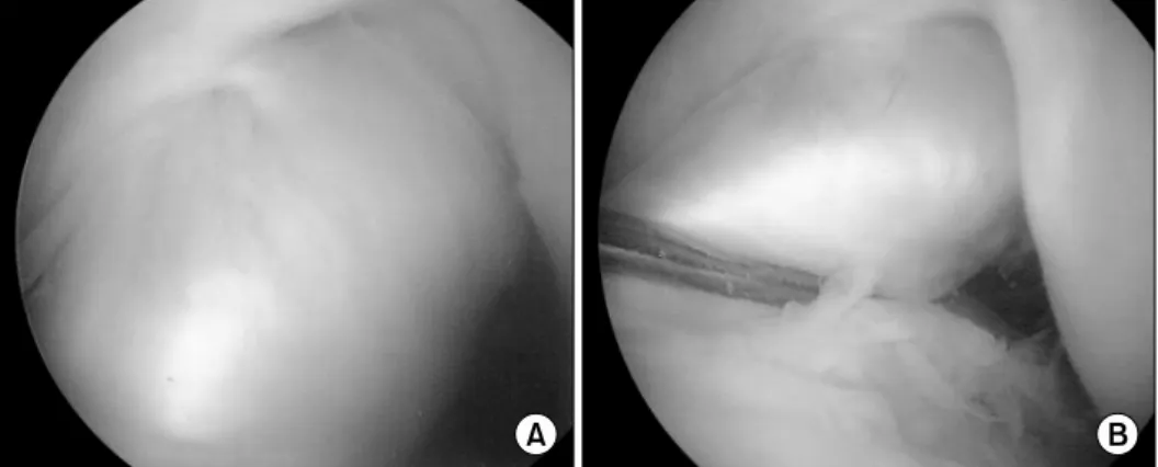 Fig. 1.  (A)  A  46-year-old  man  an  arthroscopic  finding  of  anterior  cruciate  ligament  reconstruction with hamstring  tendon  autograft  in  the  left  knee