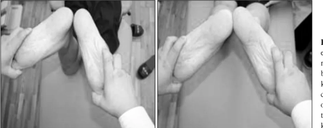 Fig. 1. Dial test. Left ankle is  externally  rotated  10  degree  more  than  the  other  side  in  both 30 degrees and 90 degree knee  flexion