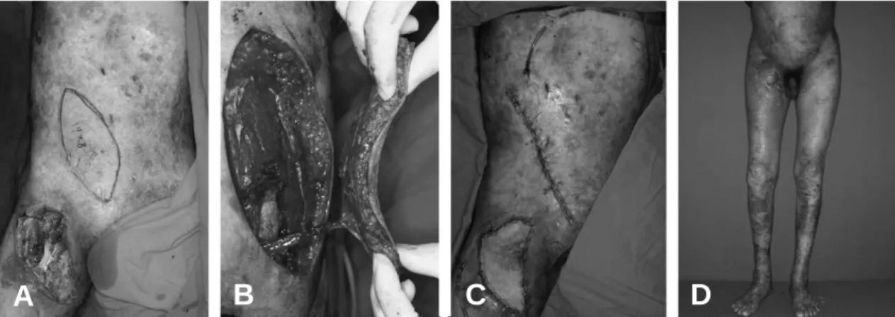 Fig. 2. (A)  Deep inferior epigastric perforator flap design after tumor resection. (B) Flap elevation