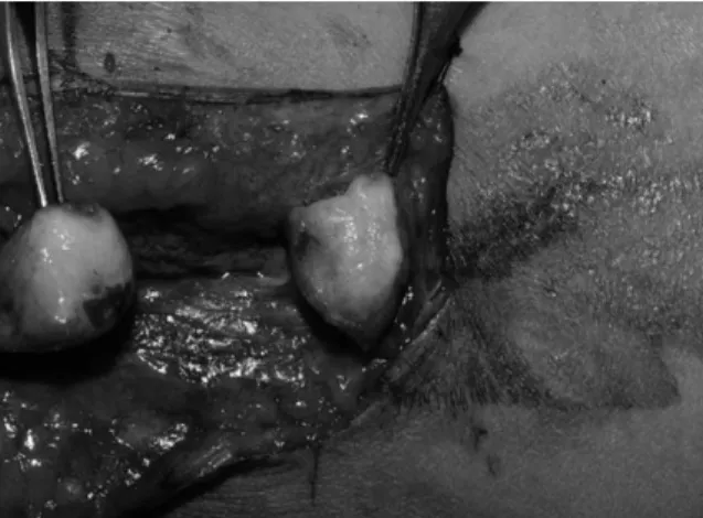 Fig. 3. After resecting the neuroma, 8 cm size nerve defect is noted.