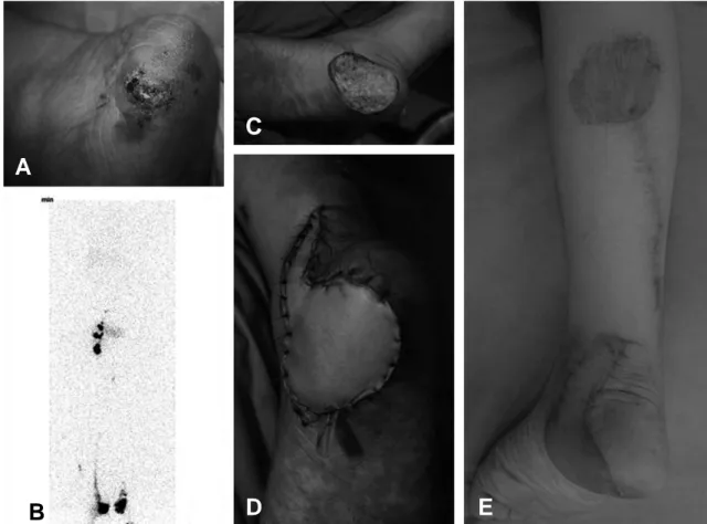 Fig. 2. (A) A 63-years-old female patient with diagnosis of malignant melanoma on her heel