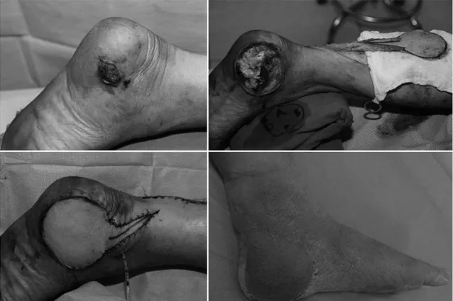 Fig. 4. The reverse sural artery flap is a good reconstruction strategy after malignant melanoma excision around heel.