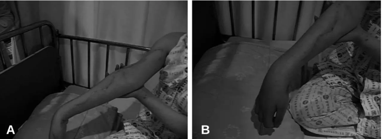 Fig. 4. (A) At postoperative 9 months, the patient could not actively flex the elbow joint
