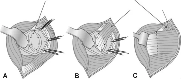 Fig. 1. (A) Six bioabsorbable suture anchors (Arrow) were inserted in glenoid labrum. (B) Pectoralis major muscle(Arrow) was attached to glenoid labrum.(C)  Pectoralis major muscle (Arrow) was placed between rotator interval.