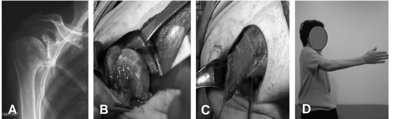 Fig. 2. (A) Preoperative radiograph showing glenohumoral arthritis. (B) Intraoperative findings shows cartilage defect