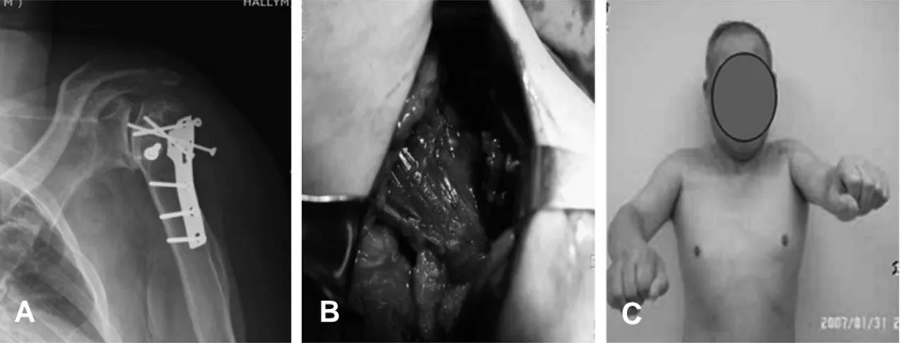 Fig. 3. (A) BPreoperative radiographs showing severe arthropathic changes of the left shoulder