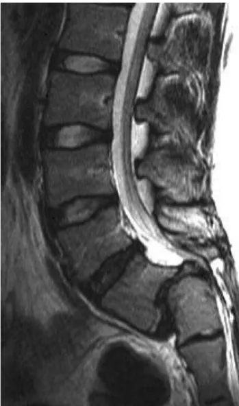 Fig. 3. MRI sagittal view of high dysplastic spondylolisthesis in a 16-year- 16-year-old girl